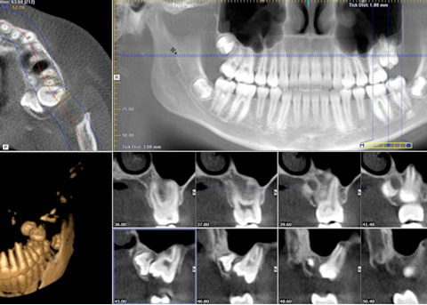 tac dentale - dentalscan