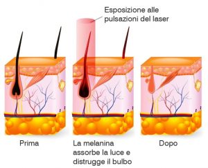 Epilazione laser Roma epilazione laser a diodo roma - Epilazione laser Roma
