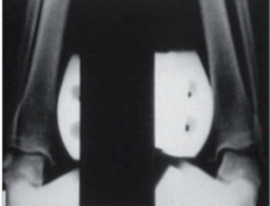 radiografie-dinamiche-caviglia