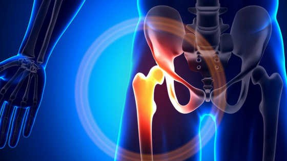 coxartrosi o artrosi dell'anca