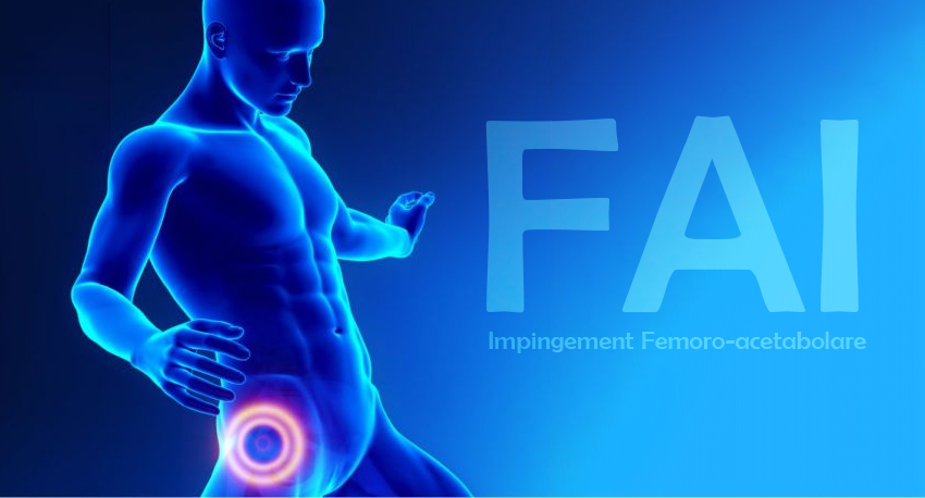 Che cosa è il FAI: Impingement Femoro-acetabolare (FAI)