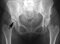 radiografia per fisioterapia per conflitto femoro acetabolare