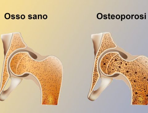 osteoporosi osteopenia