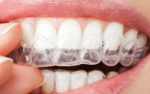 Gnatologia: bite gnatologia