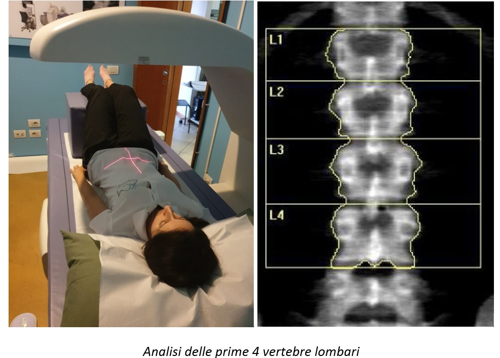 Che cos’è la MOC: Analisi delle prime 4 vertebre lombari