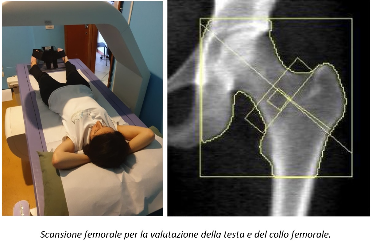 Che cos’è la MOC: Scansione femorale per la valutazione della testa e del collo femorale. 