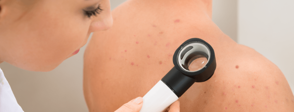 La dermatologia al Centro Medico Arcidiacono - Visita di Controllo Nei