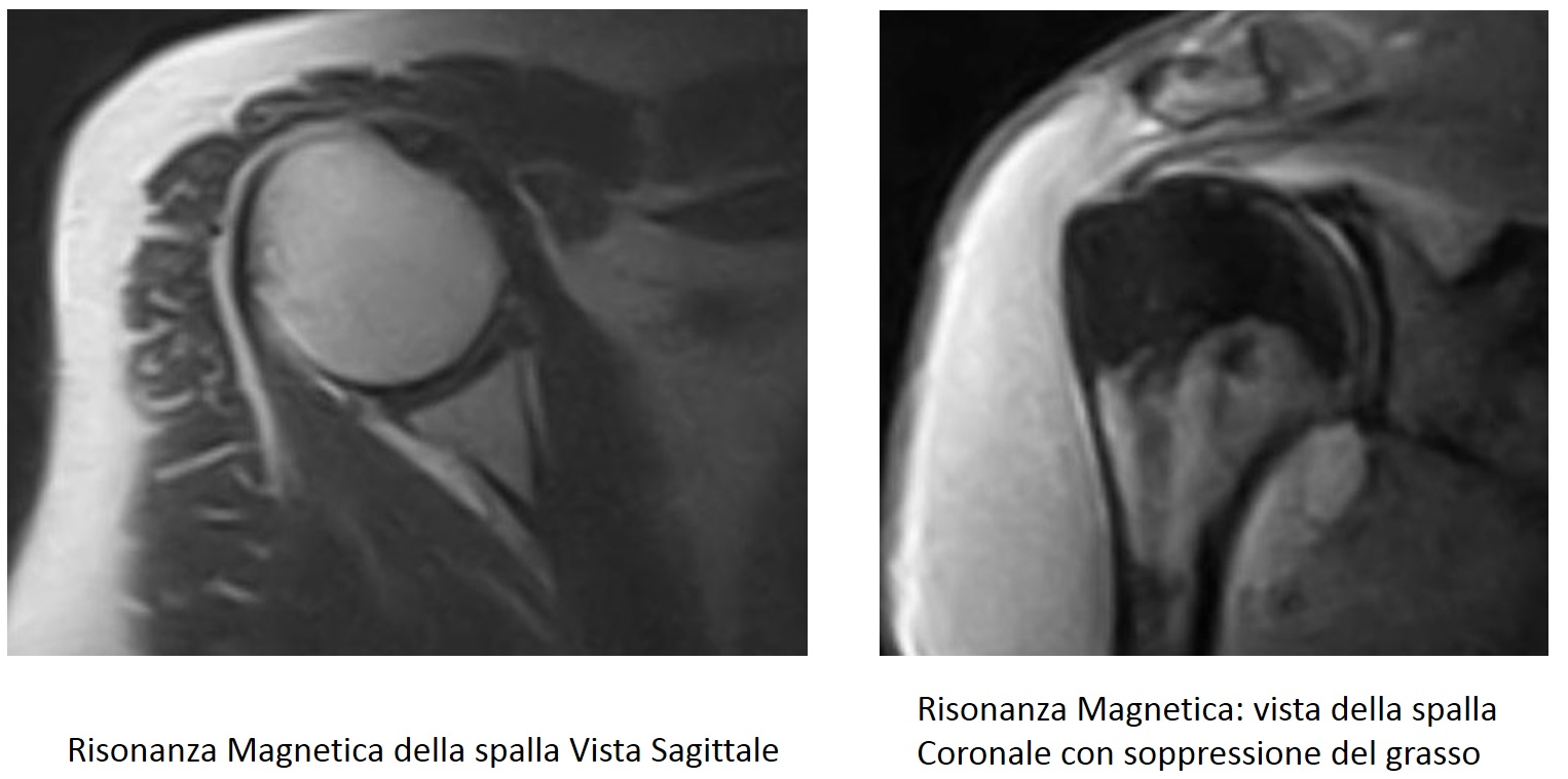 rm della spalla