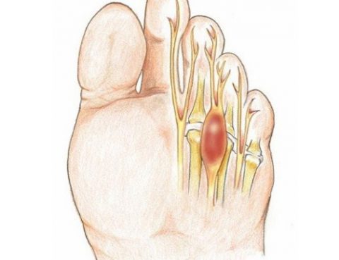 Neuroma di Morton -RM aperta