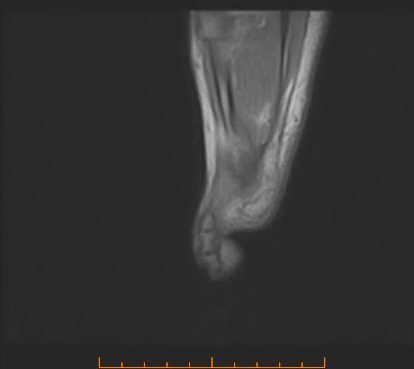 RISONANZA MAGNETICA DEL PIEDE - PIEDE SAGGITALE