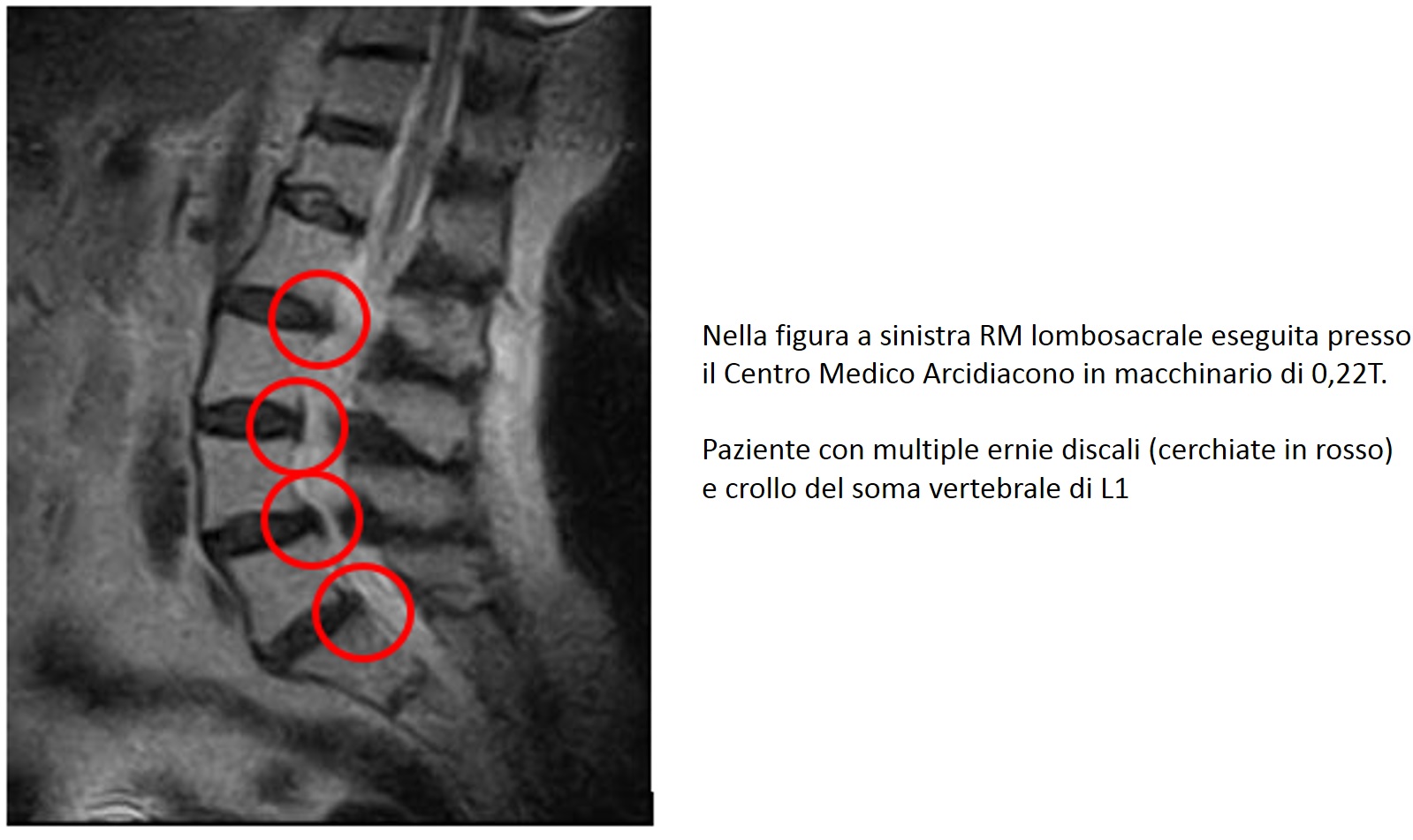 Risonanza Magnetica Lombare