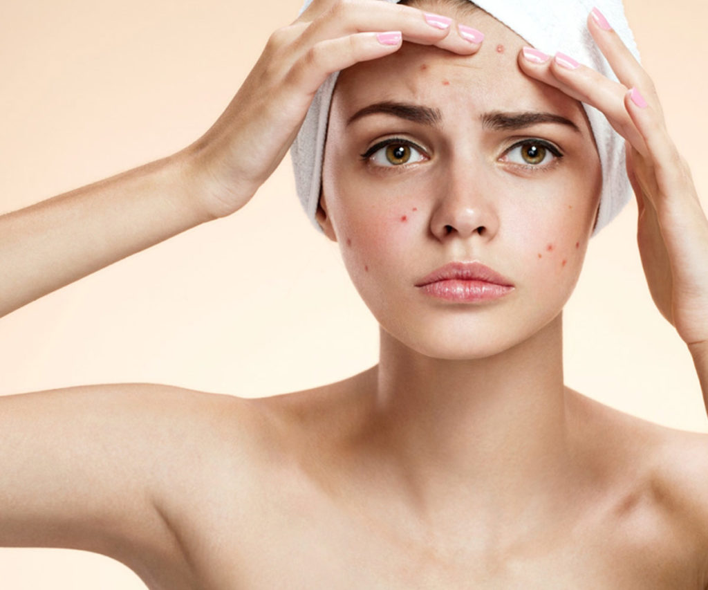 combattere l'acne - parliamo di acne 2 combattere l'acne - parliamo di acne