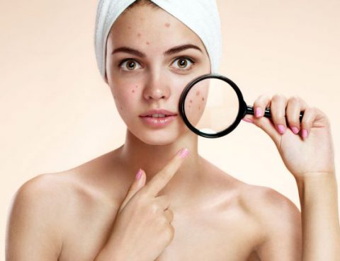 acne - combattere l'acne - parliamo di acne 2