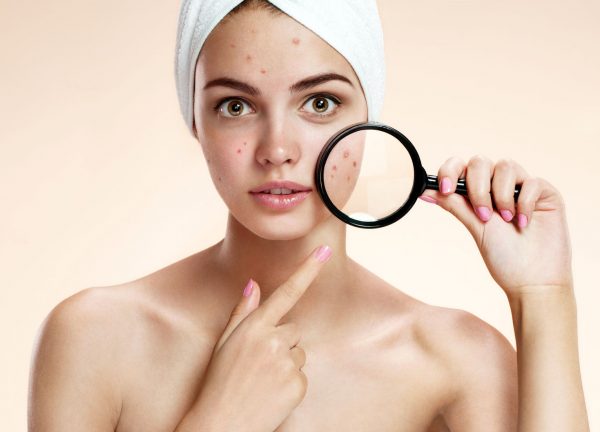 acne - combattere l'acne - parliamo di acne 2