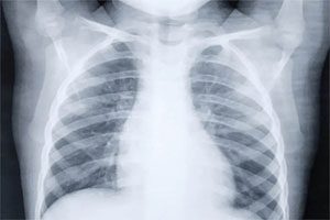 Radiografia torace svela Covid in asintomatici