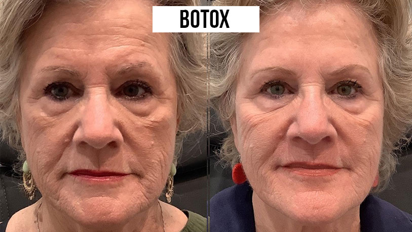 botox